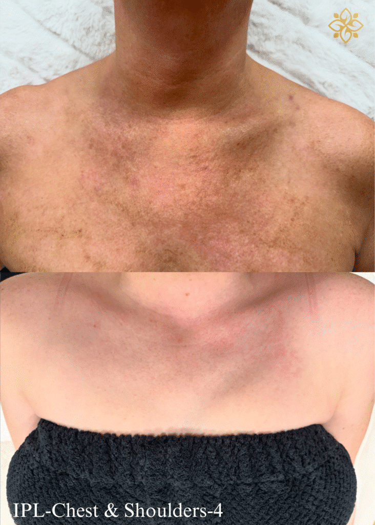 PYBL Before & After #6 (2)